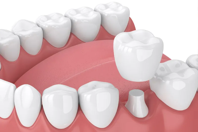 Dental Crowns