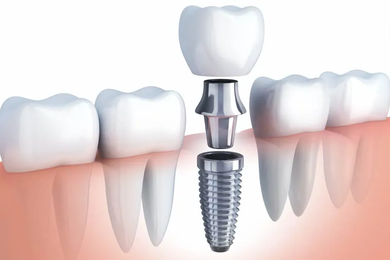 Implant Dentist in Lakewood
