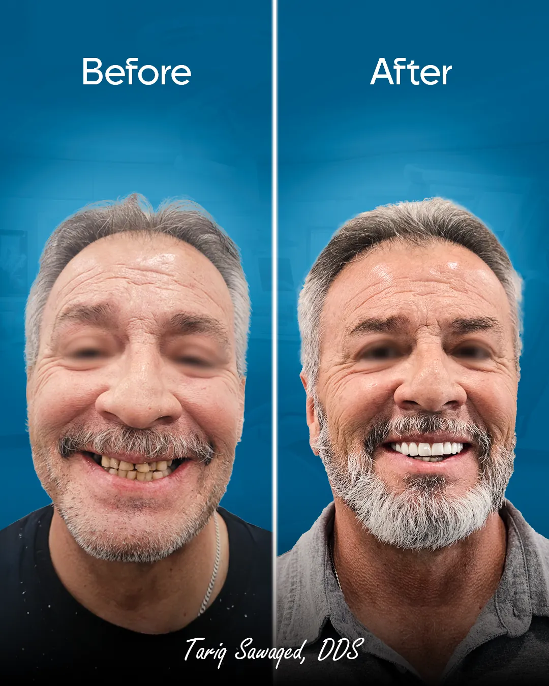 Before and after smile transformation, result 9