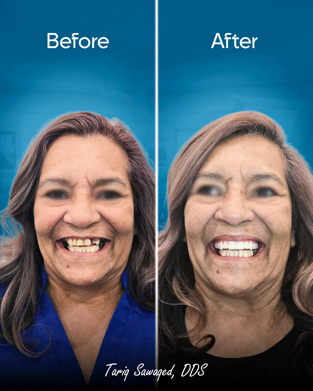 Before and after smile transformation, result 18