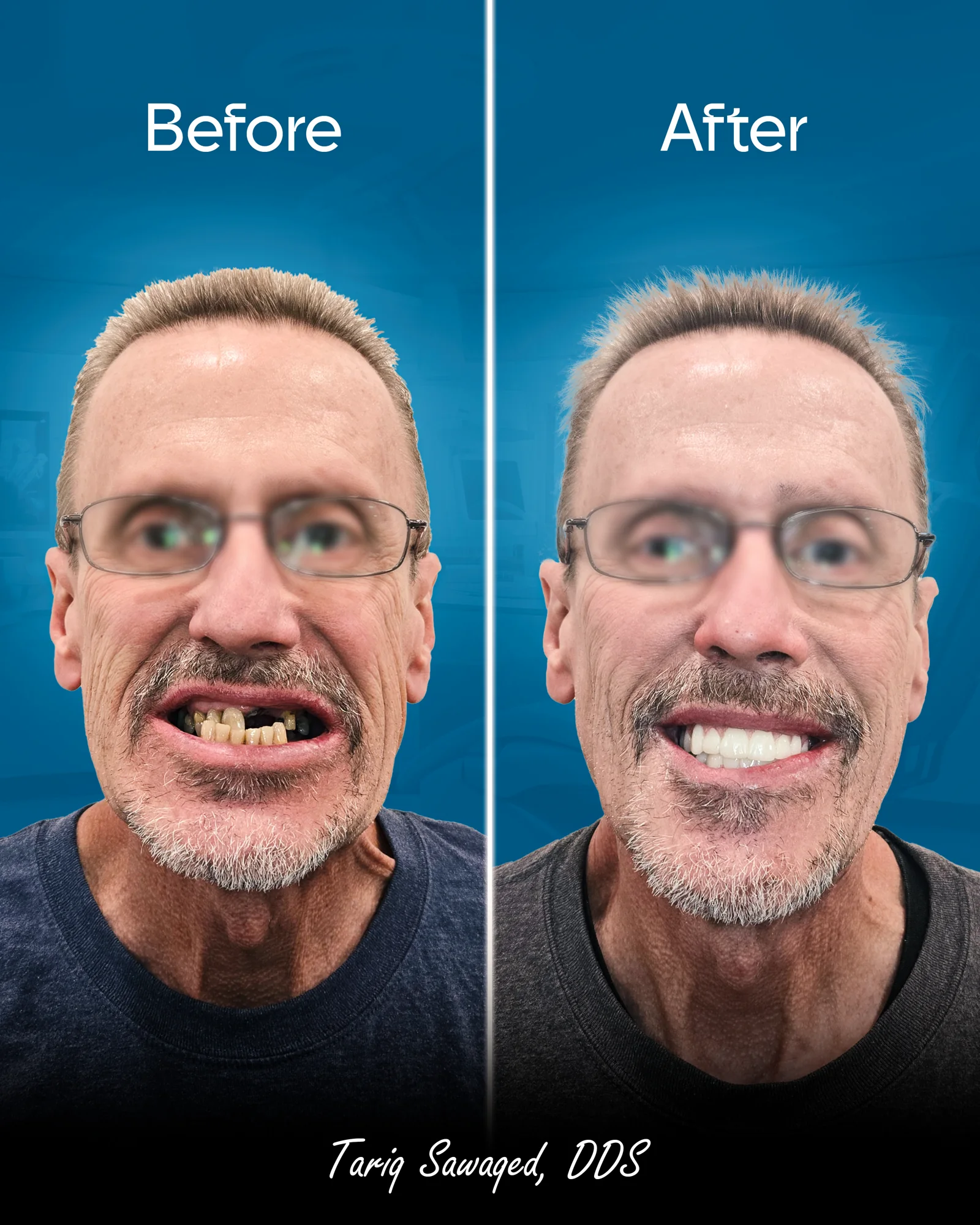 Before and after smile transformation, result 10