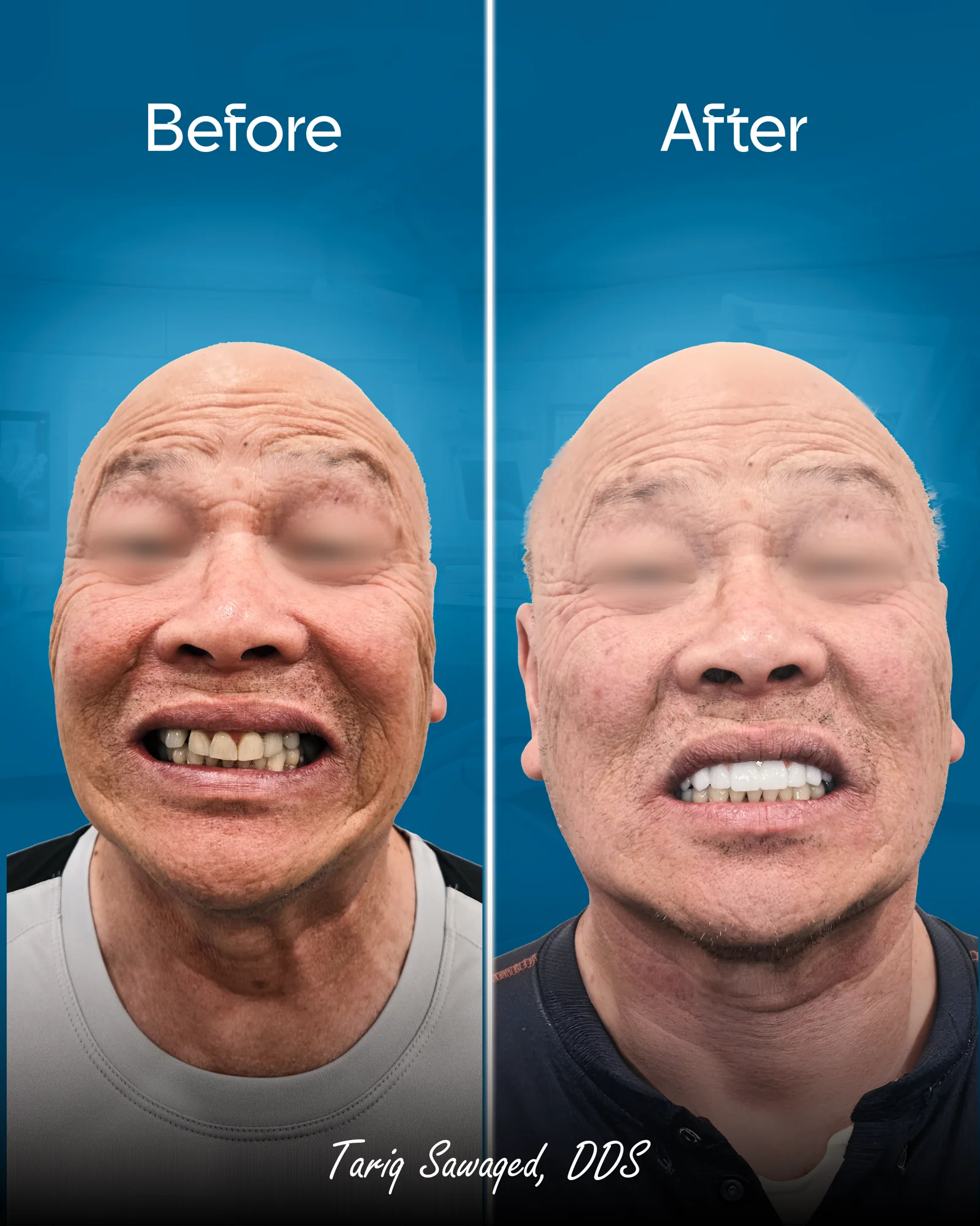 Before and after smile transformation, result 16