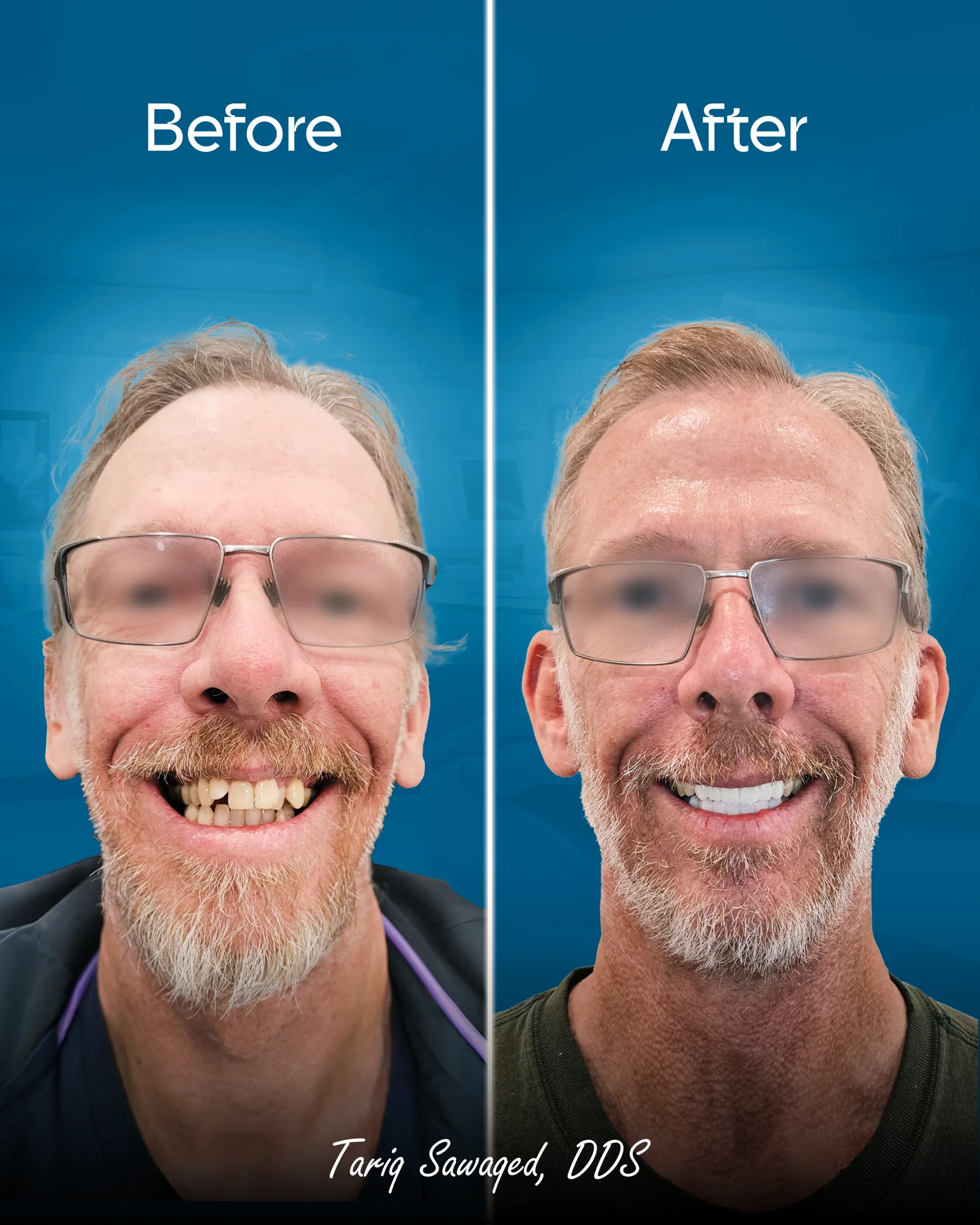 Before and after smile transformation, result 20
