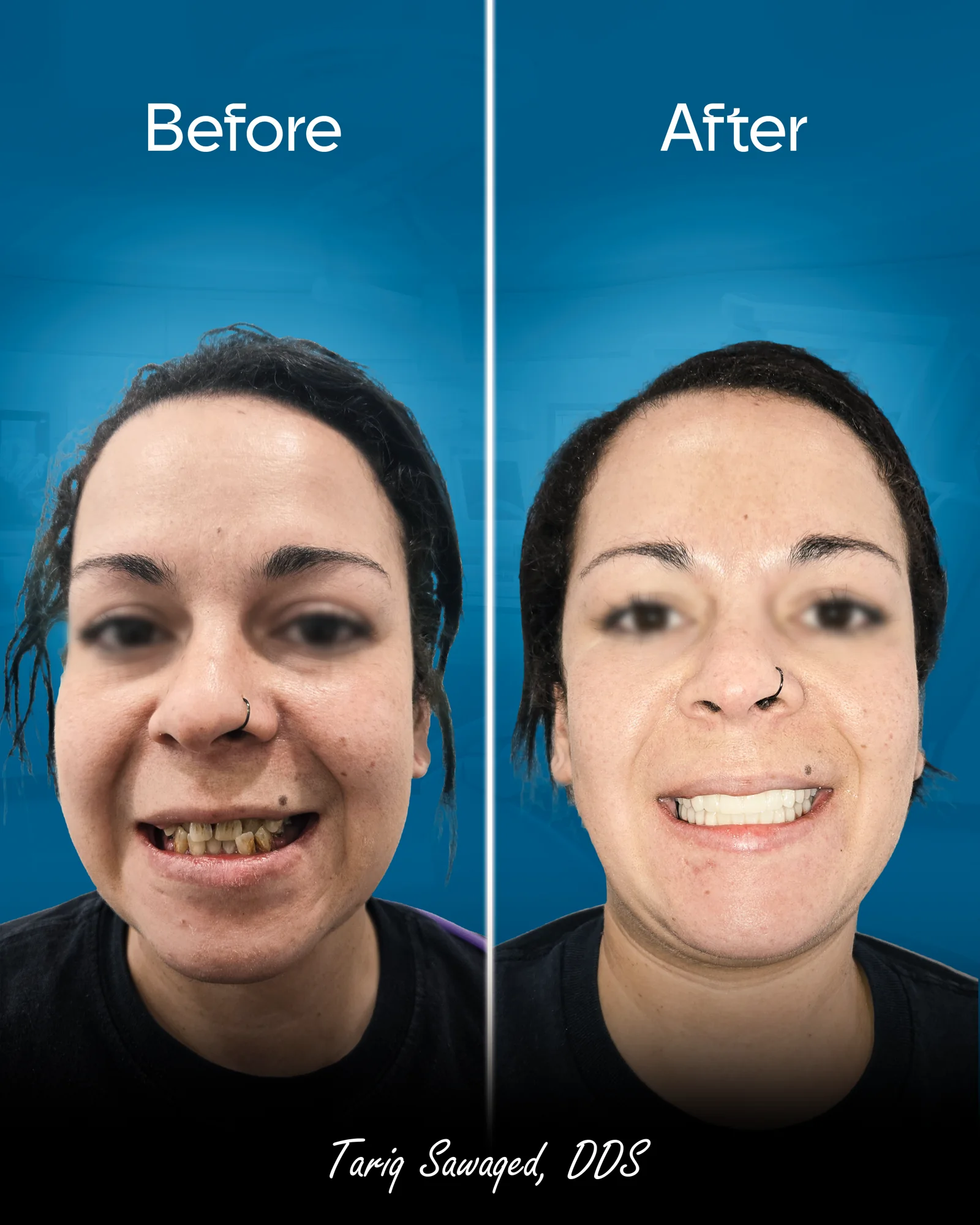 Before and after smile transformation, result 21
