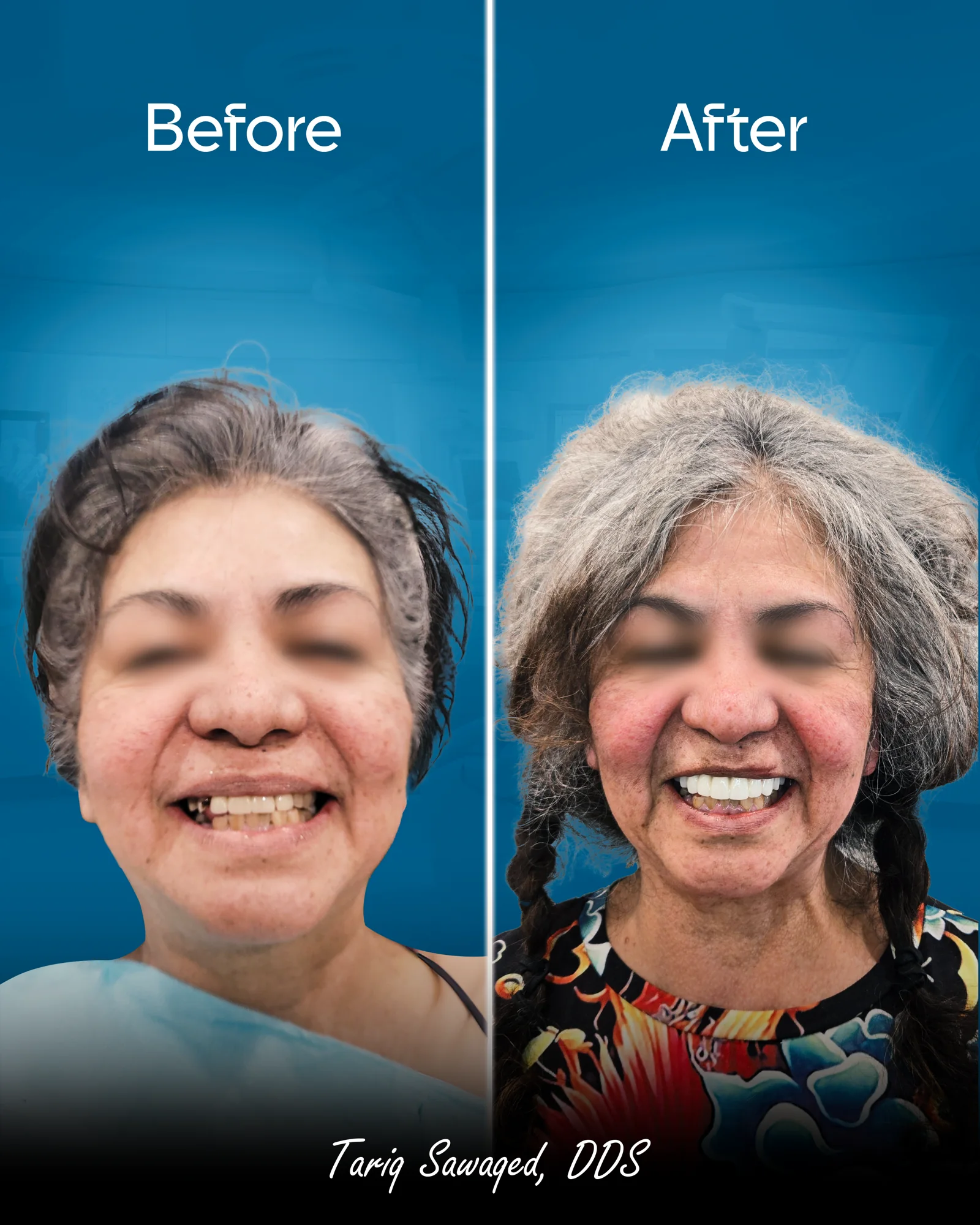 Before and after smile transformation, result 11