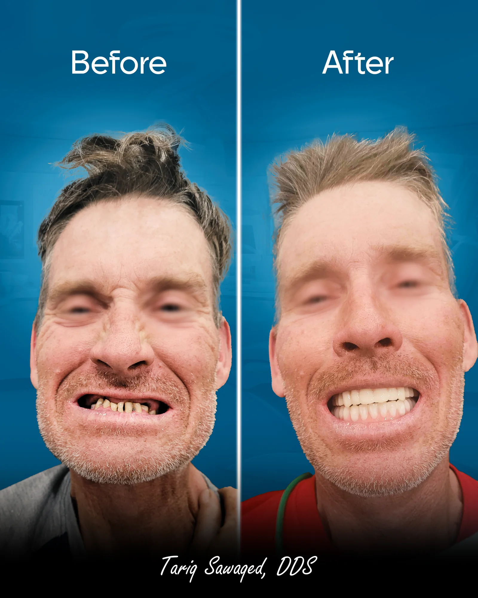 Before and after smile transformation, result 13