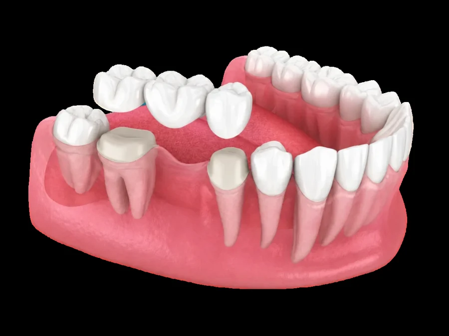 Implant-Supported Bridge