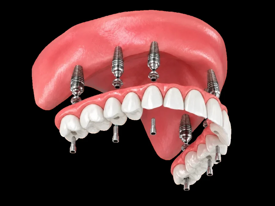 Full-Arch Dental Implants