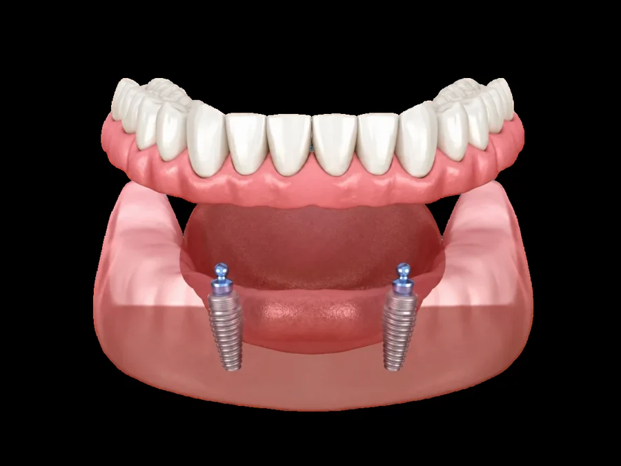 Snap-On Dentures
