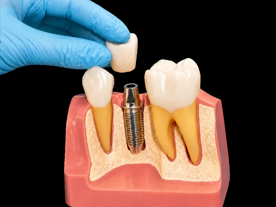 Single Tooth Implant