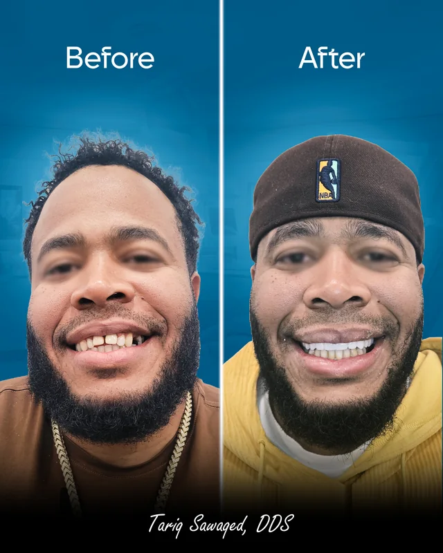 Before and after smile transformation, result 2