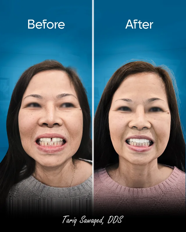 Before and after smile transformation, result 3