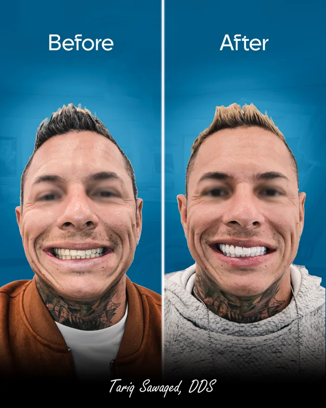 Before and after smile transformation, result 4