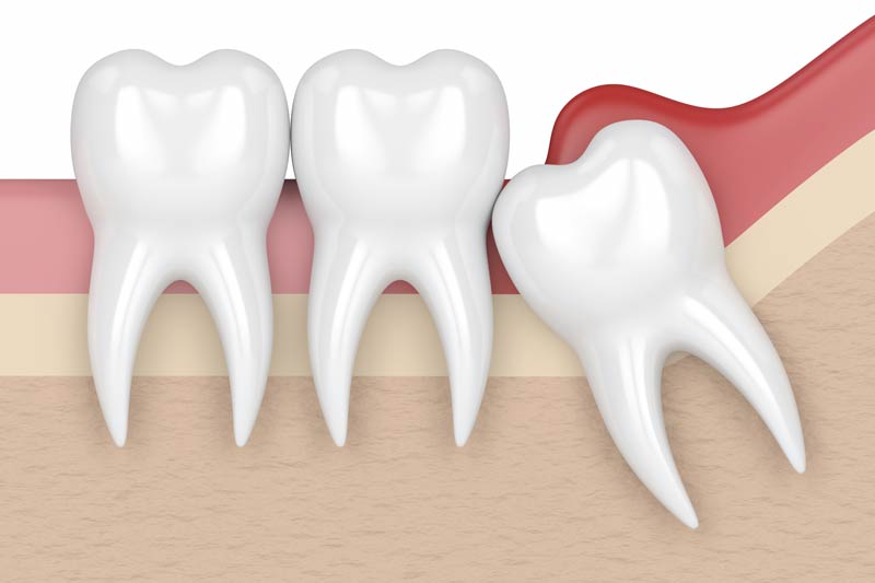 Wisdom Tooth Removal in Lakewood